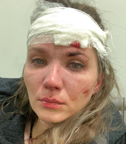 Анастасия Веденская получила травму головы
