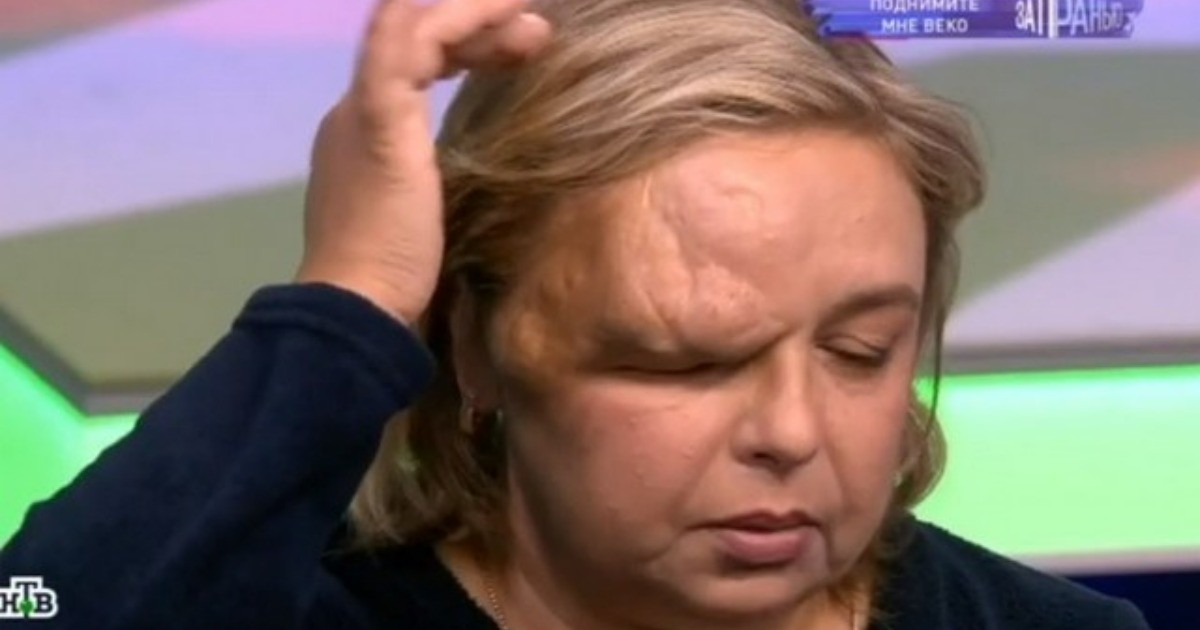 Женщина ослепла из-за огромной опухоли над глазом, разросшейся до половины головы