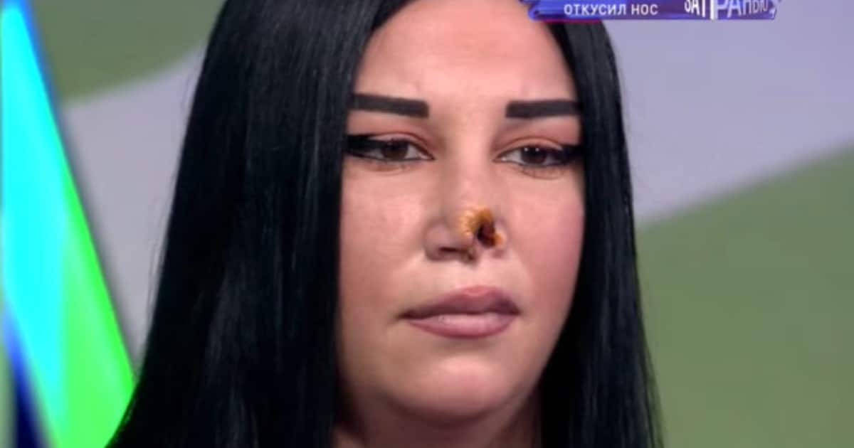 Сосед по комнате откусил матери троих детей нос во время драки: женщина может умереть из-за инфекции