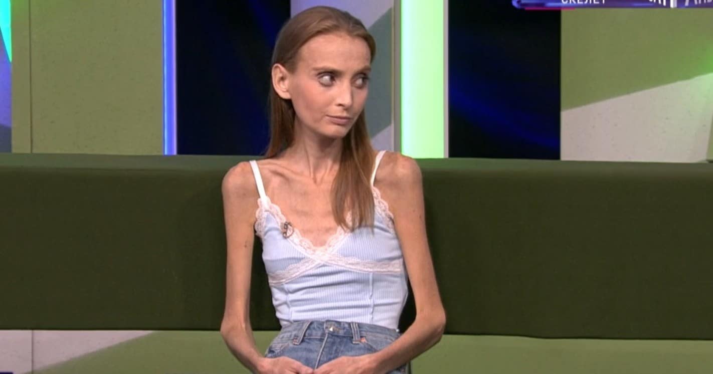 «Критическое состояние, в шаге от смерти»: 26-летняя Розалина из Татарстана весит 29 кг