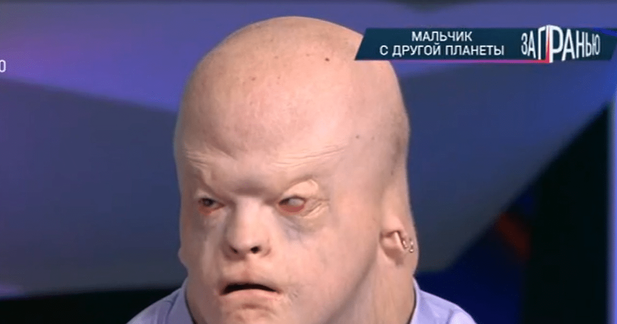 В мире всего 16 таких людей: 18-летний Алексей с внешностью гуманоида живет в приемной семье