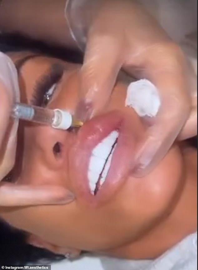 Кэти поделилась видео, как накачивает губы филлером