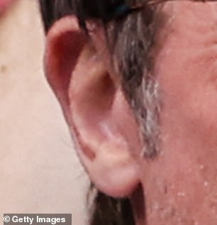 Доктор Джонни заявил, что ухо Брэда имело «классический вид шрама после подтяжки лица».