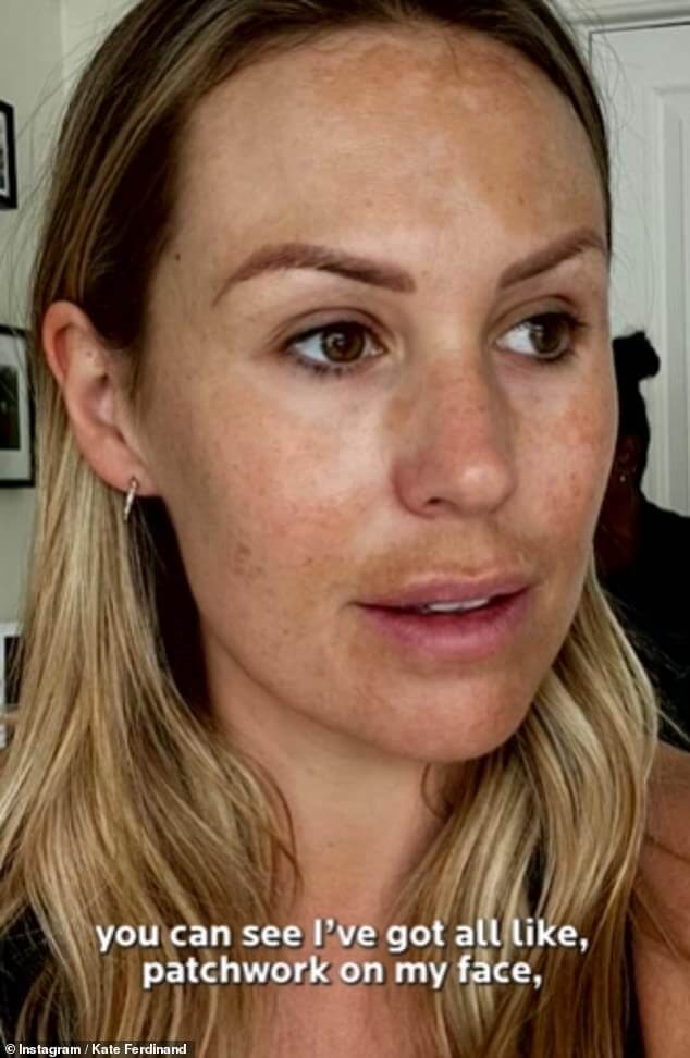 Кейт Фердинанд смело рассказывает о своей тайной битве за кожу с помощью снимка без макияжа после того, как призналась, что из-за этого состояния она чувствует себя «неуверенно»