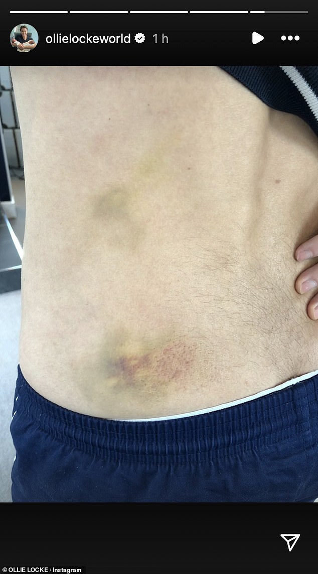 Олли поделился в Instagram фотографией своей избитой и ушибленной спины после страшного опыта, чтобы подчеркнуть серьезность преступлений в городе.
