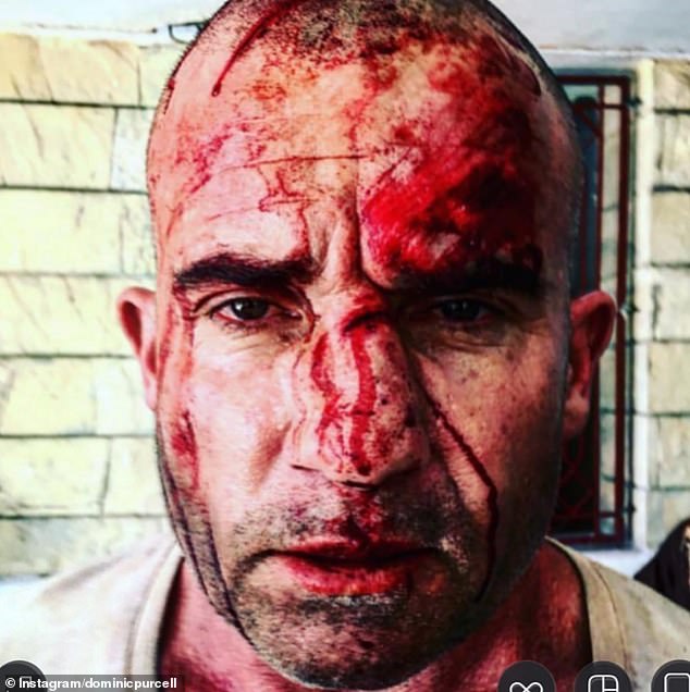 Доминик Перселл шокировал своих подписчиков графической фотографией, опубликованной в Instagram, на которой показаны серьезные травмы, которые он получил во время съемок.