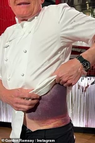 На видео Гордон задрал куртку своего шеф-повара, чтобы обнажить свои травмы: одна сторона его тела покрыта черными и фиолетовыми синяками.