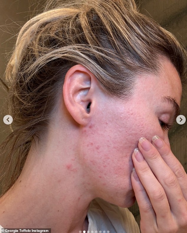 В откровенной серии фотографий Тофф продемонстрировала свои трудности, опубликовав фотографии своего последнего обострения.