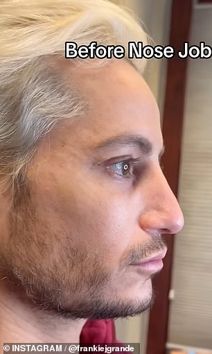 В июле Фрэнки выложил в социальные сети фотографии до и после пластики носа, начав с фото до (на фото).